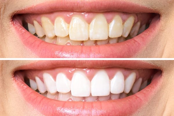 Wybielanie zębów dentysta opole